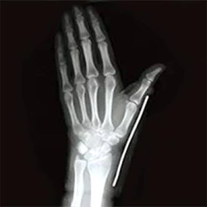 شصت بند نئوپرن آتل دار برند تسکین طب